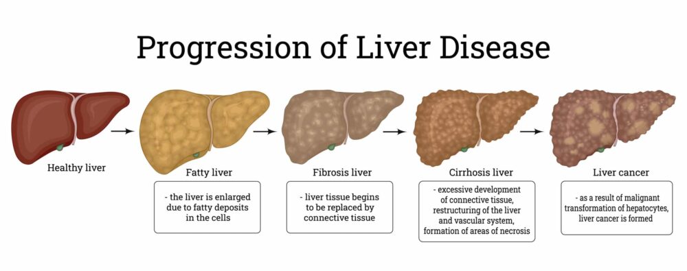 Fatty Liver Progession